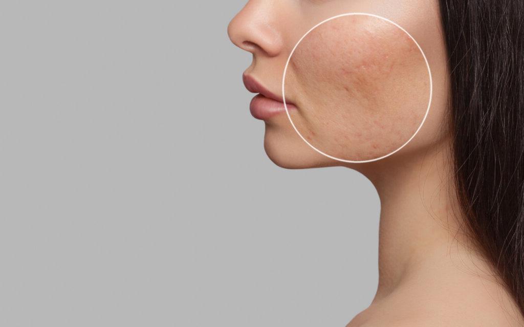 How to treat adult acne